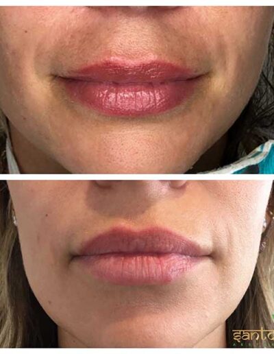 Dissolving Fillers Before and After